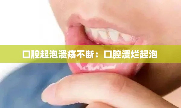 口腔起泡溃疡不断：口腔溃烂起泡 