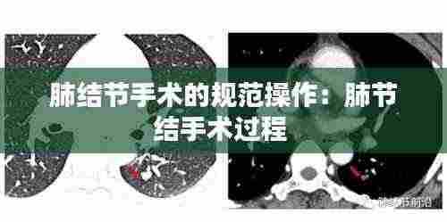 肺结节手术的规范操作:肺节结手术过程