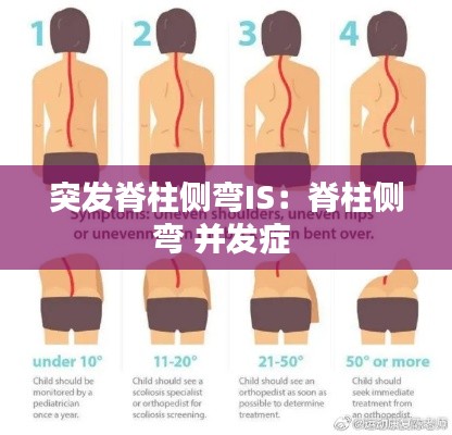 突发脊柱侧弯IS:脊柱侧弯 并发症